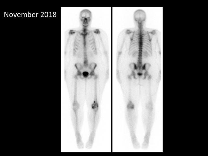 Figure 4 for case bone island ( RID4004 )